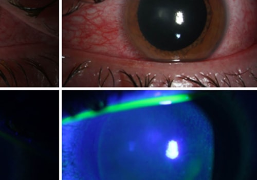 What Does UV-C Radiation Do to Humans?